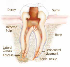 How do you treat infected gums following a root canal?
