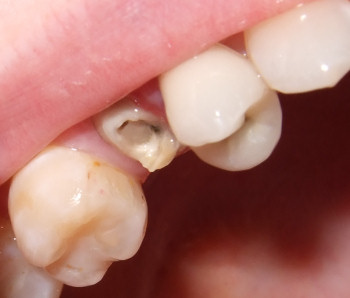Dental Crown Pictures