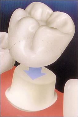 tooth crown procedure