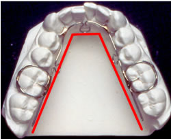 Narrow Dental Arch