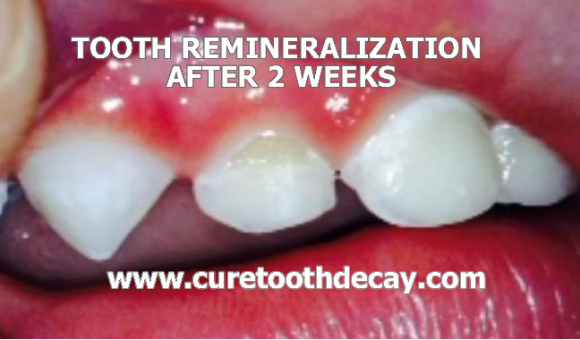 baby tooth remineralization after 2 weeks