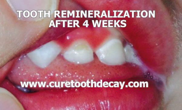 baby tooth remineralizing after 4 weeks of special food