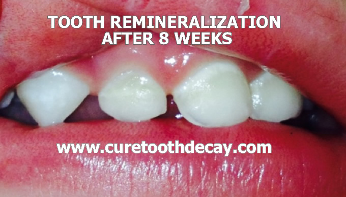 baby tooth remineralization after 8 weeks
