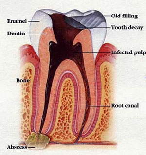 Tooth Decay Image with Pulp Damage