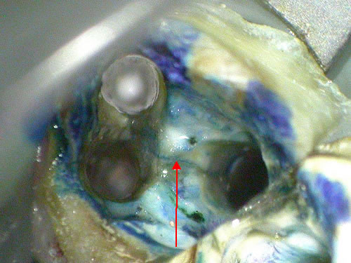 Cracked Tooth Under Root Canal