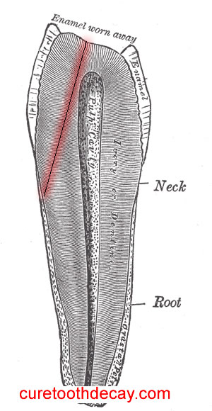 Cracked Tooth