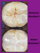 Dental Sealants