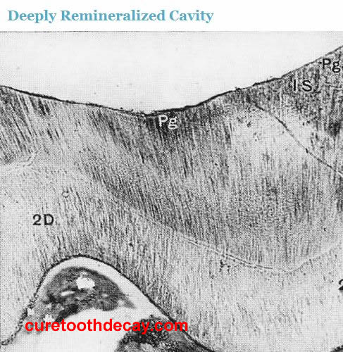 Deeply Remineralized Cavity