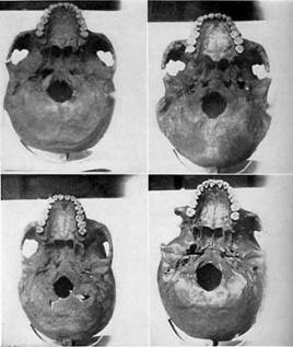 Skulls with No Decayed Teeth