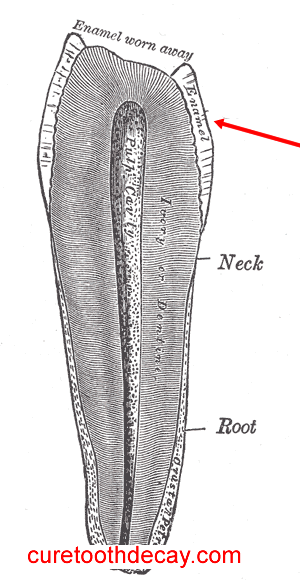 Tooth Cavity Illustration