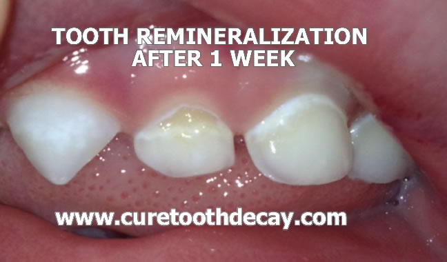 tooth remienralization week 1