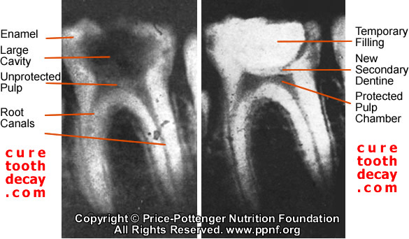 Cure Tooth Decay New Secondary Dentine Forming, Tooth Decay Reversing